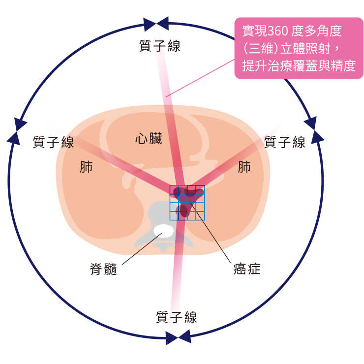 強度変調陽子線治療は360度さまざまな方向から照射