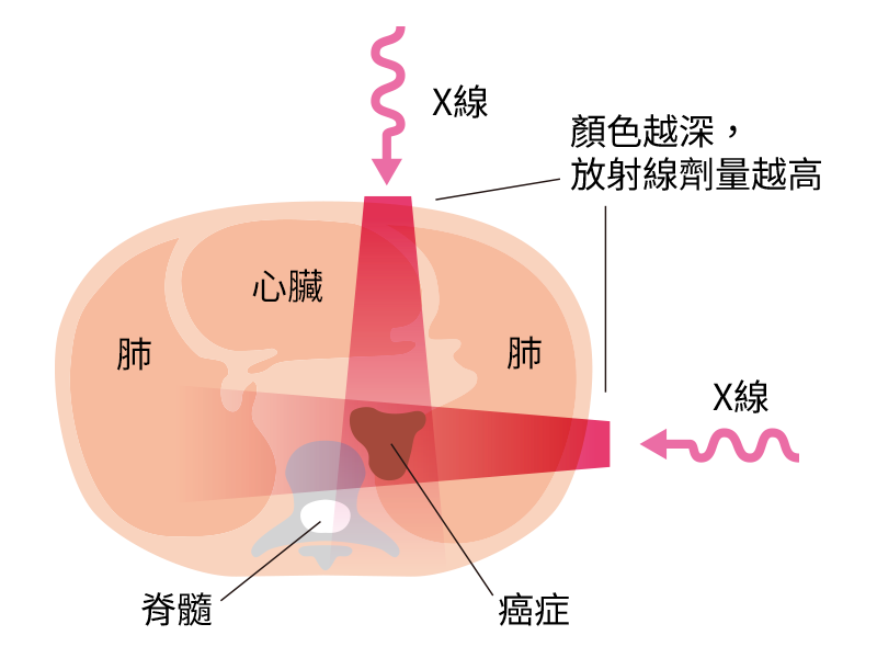 従来の放射線治療の図