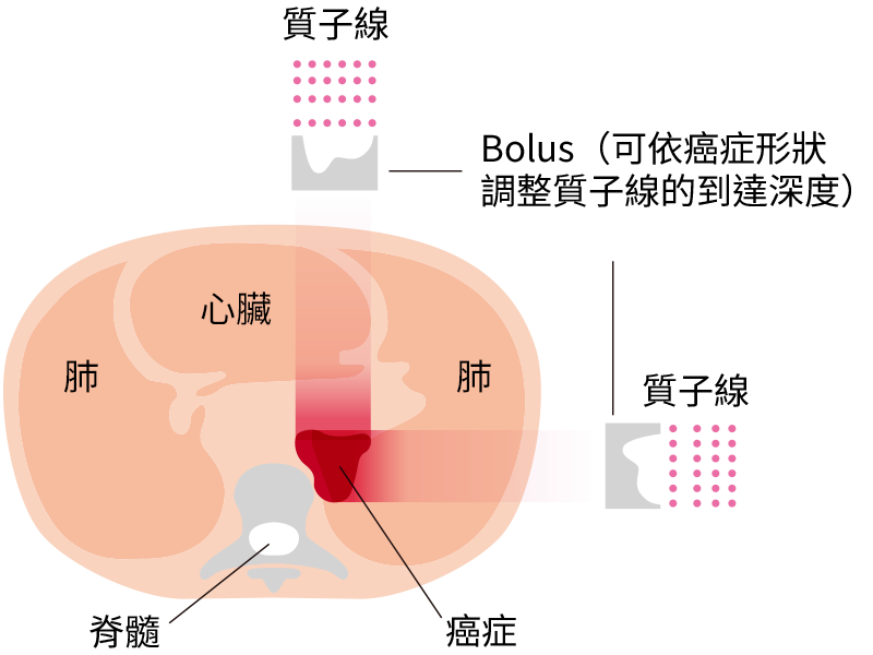 陽子線(粒子線)治療の図