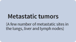 Brain metastasis   Bone metastasis  Breast cancer and more