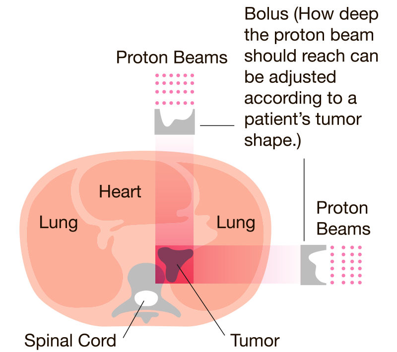 Proton (particle beam) therapy